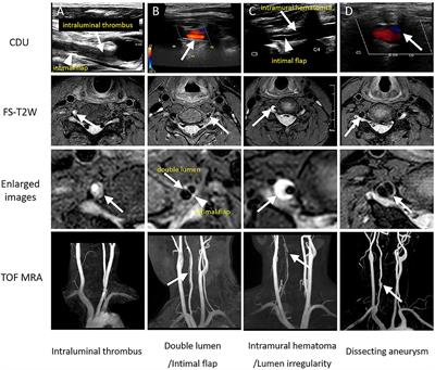 Predictors of ischemic events in patients with unilateral extracranial vertebral artery dissection: A single-center exploratory study